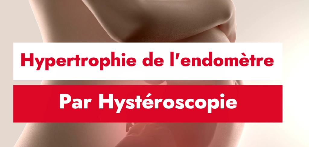 Hypertrophie de l'endomètre par hystéroscopie